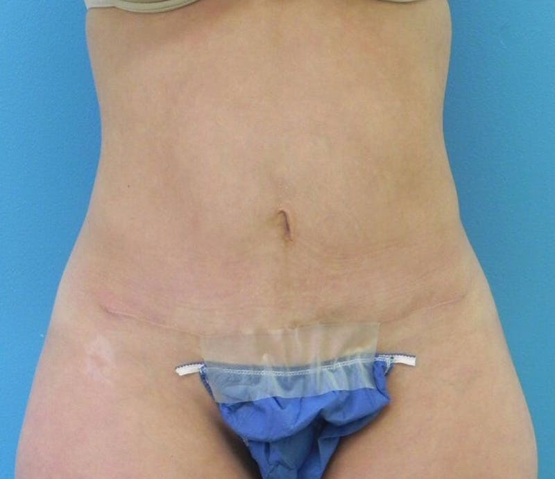 Abdominoplasty Before & After Gallery - Patient 485355 - Image 2