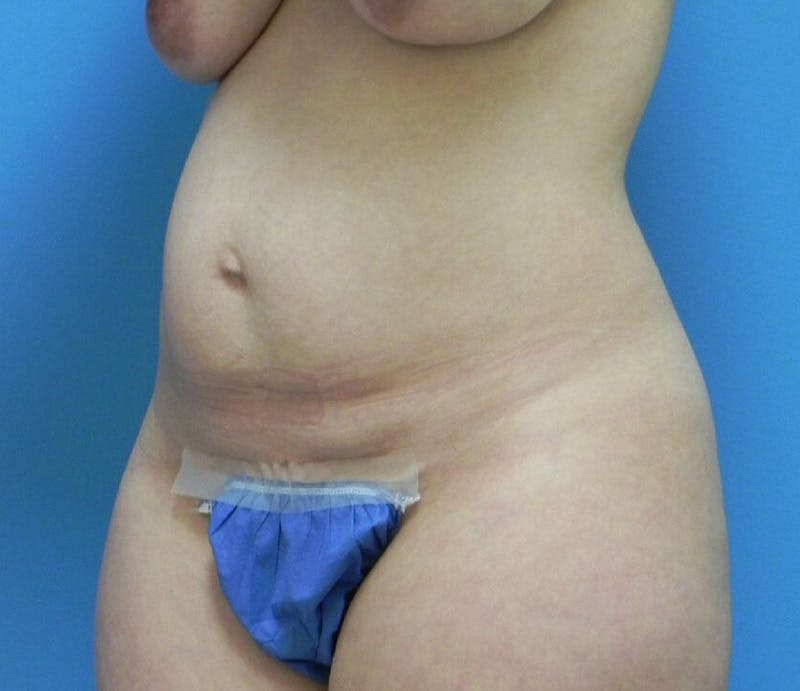 Abdominoplasty Before & After Gallery - Patient 485355 - Image 3