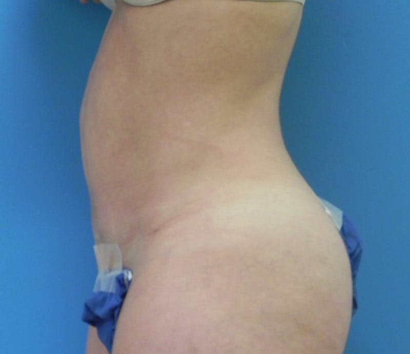 Abdominoplasty Before & After Gallery - Patient 485355 - Image 6