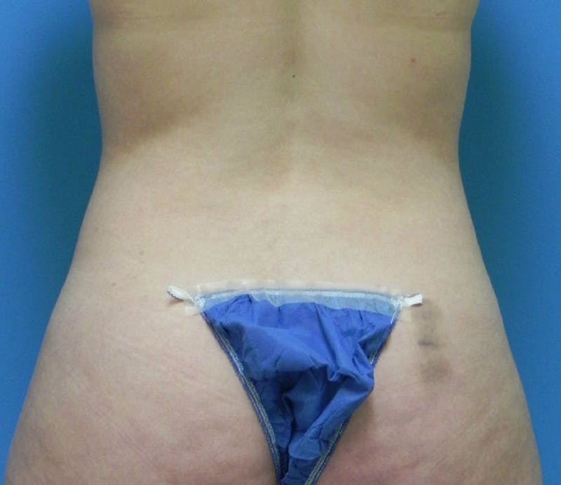Abdominoplasty Before & After Gallery - Patient 485355 - Image 9