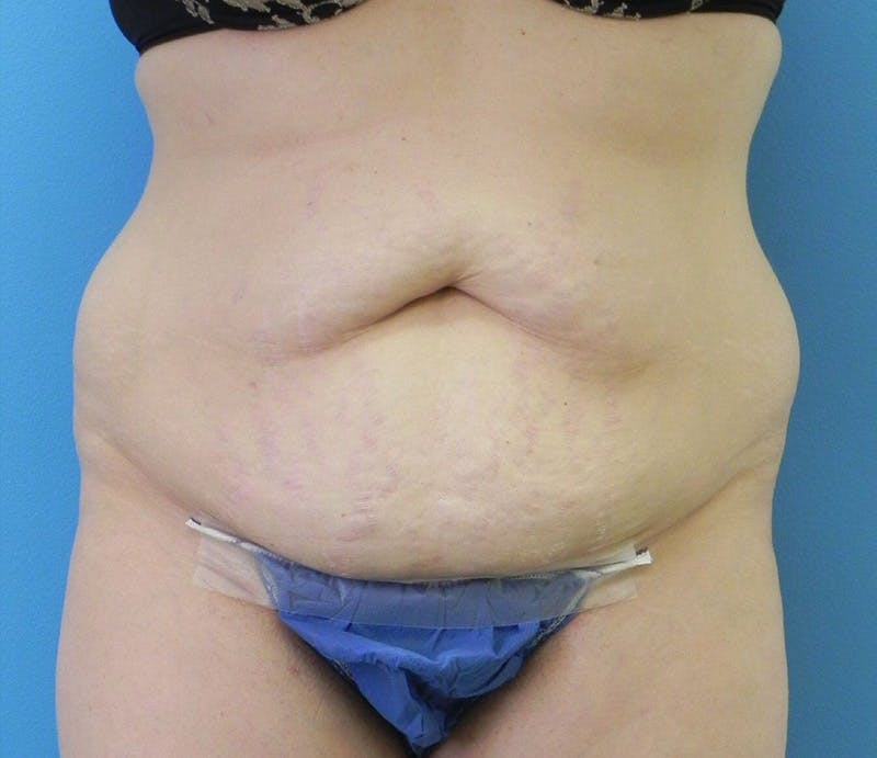 Abdominoplasty Before & After Gallery - Patient 294161 - Image 1