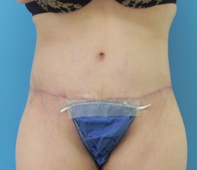 Abdominoplasty Before & After Gallery - Patient 294161 - Image 2