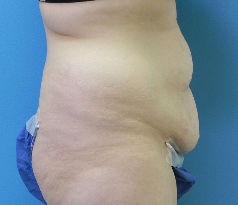 Abdominoplasty Before & After Gallery - Patient 294161 - Image 7
