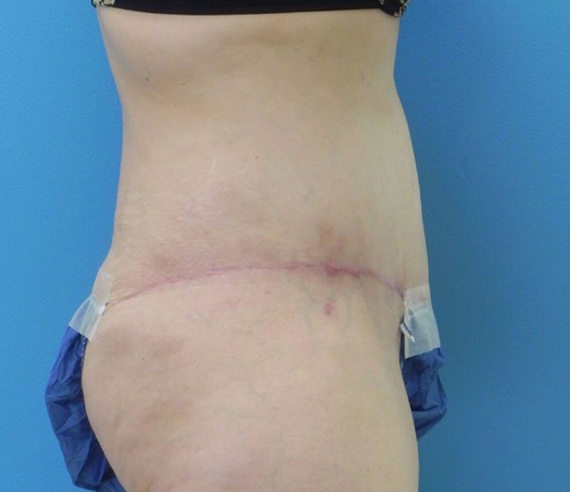 Abdominoplasty Before & After Gallery - Patient 294161 - Image 8