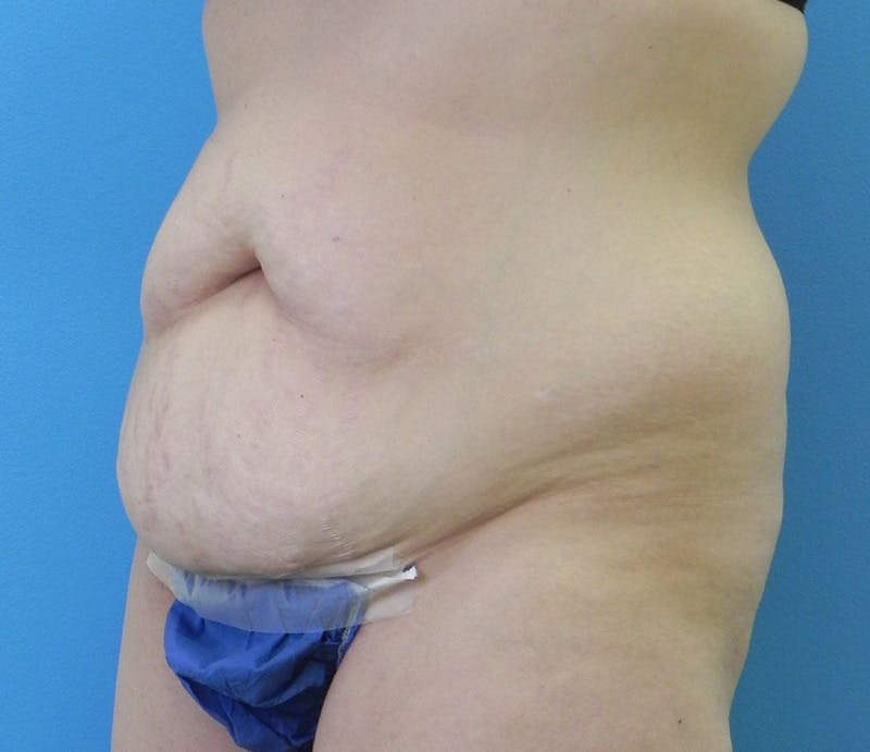 Abdominoplasty Before & After Gallery - Patient 294161 - Image 3