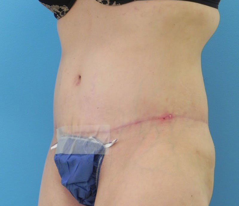 Abdominoplasty Before & After Gallery - Patient 294161 - Image 4