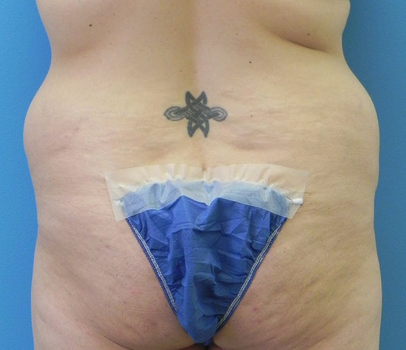 Abdominoplasty Before & After Gallery - Patient 294161 - Image 9