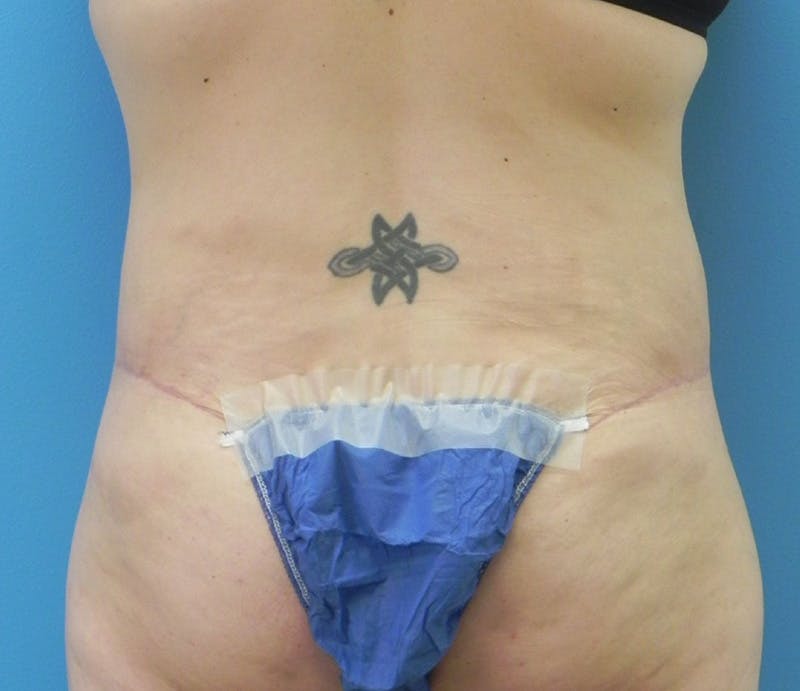 Abdominoplasty Before & After Gallery - Patient 294161 - Image 10