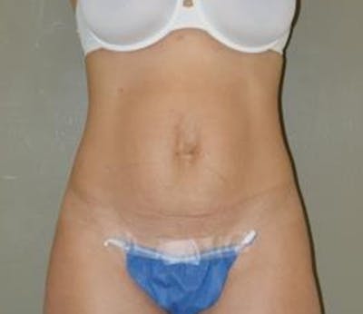 Abdominoplasty Before & After Gallery - Patient 336538 - Image 1
