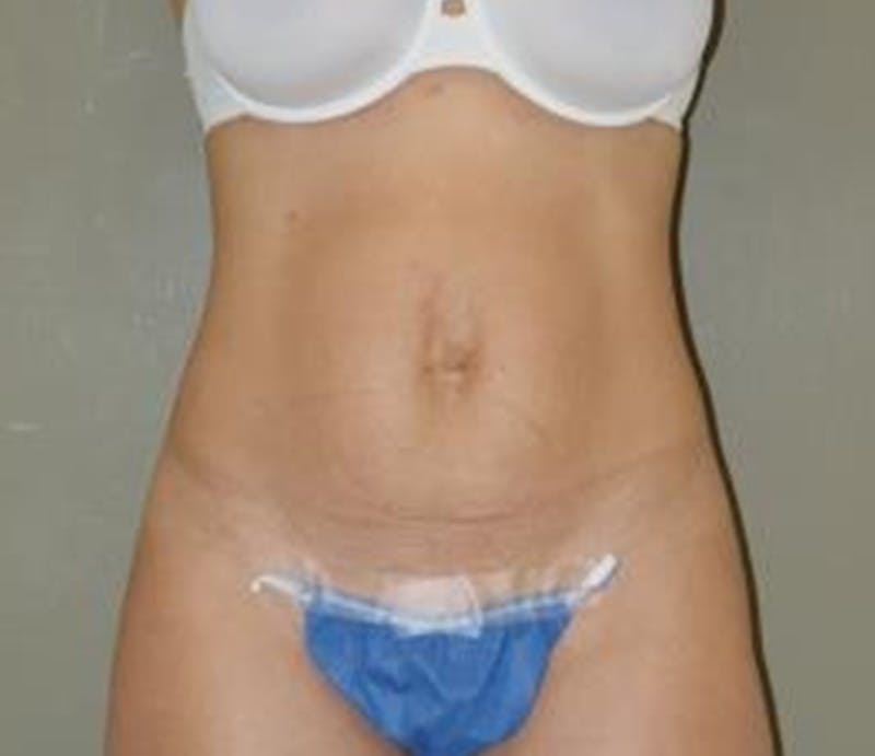 Abdominoplasty Before & After Gallery - Patient 336538 - Image 1