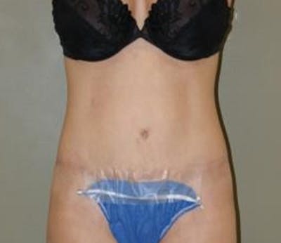 Abdominoplasty Before & After Gallery - Patient 336538 - Image 2