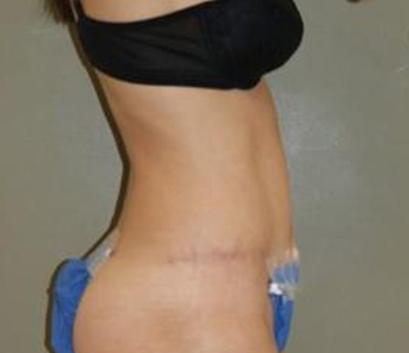 Abdominoplasty Before & After Gallery - Patient 336538 - Image 4