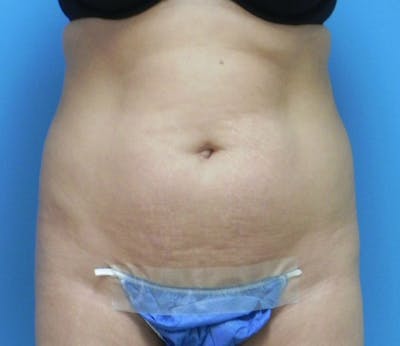 Abdominoplasty Before & After Gallery - Patient 200608 - Image 1