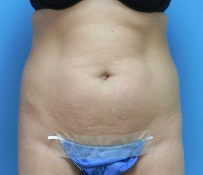 Abdominoplasty Before & After Gallery - Patient 200608 - Image 1