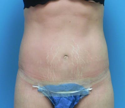 Abdominoplasty Before & After Gallery - Patient 200608 - Image 2