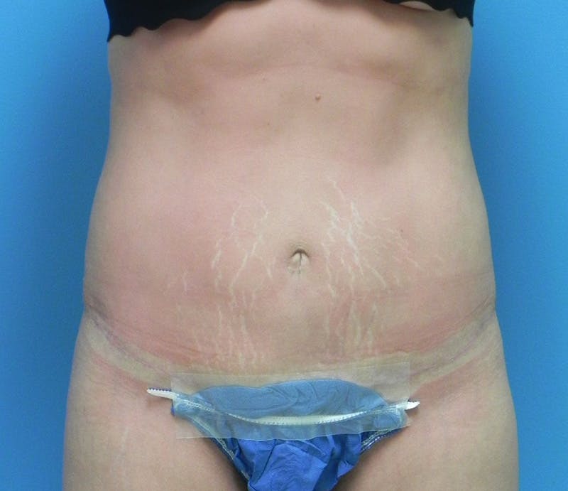 Abdominoplasty Before & After Gallery - Patient 200608 - Image 2