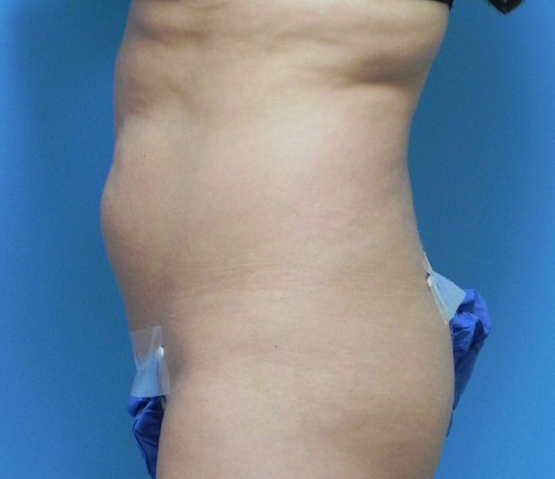 Abdominoplasty Before & After Gallery - Patient 200608 - Image 5