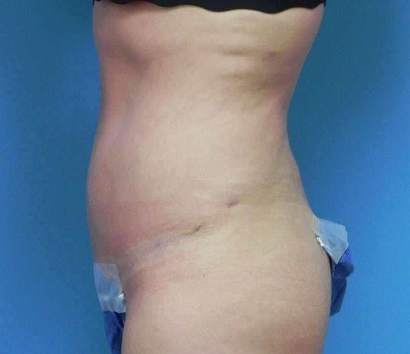 Abdominoplasty Before & After Gallery - Patient 200608 - Image 6