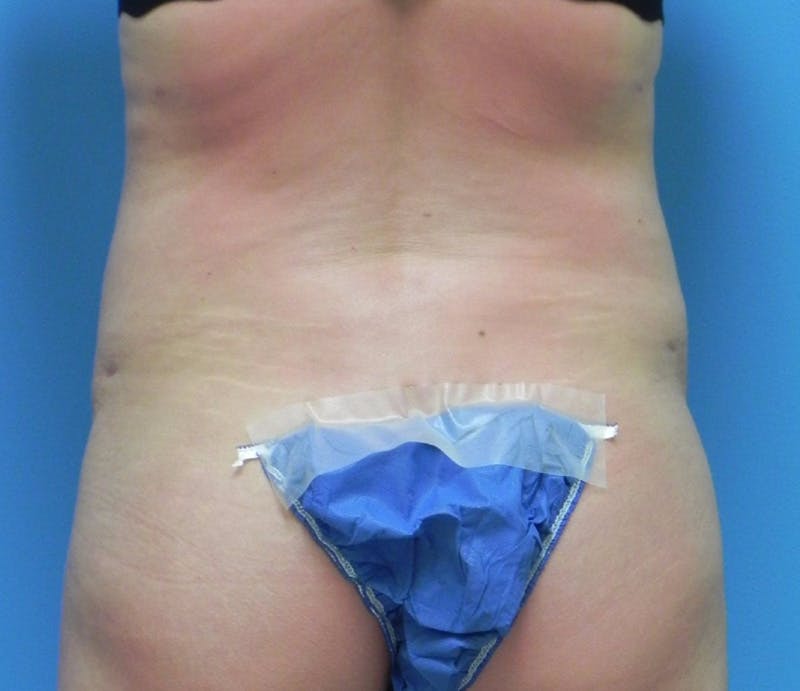 Abdominoplasty Before & After Gallery - Patient 200608 - Image 8