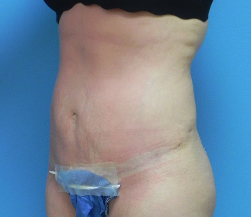 Abdominoplasty Before & After Gallery - Patient 200608 - Image 4