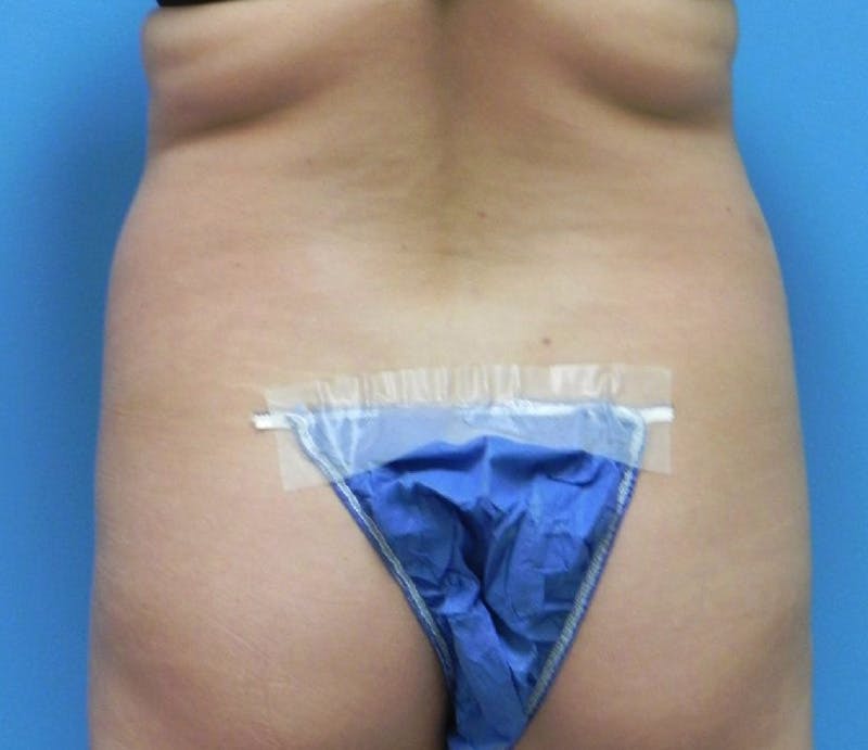 Abdominoplasty Before & After Gallery - Patient 200608 - Image 7