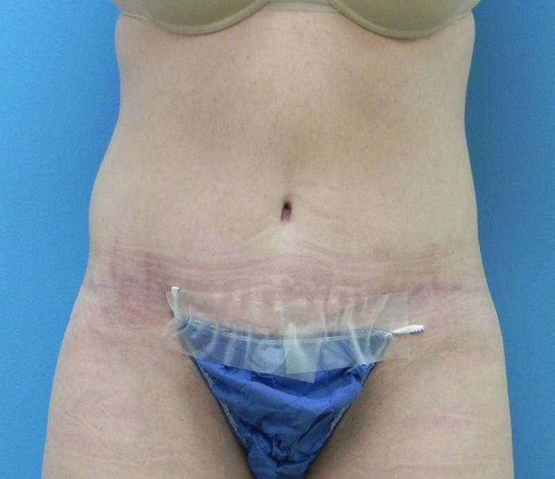 Abdominoplasty Before & After Gallery - Patient 202030 - Image 2