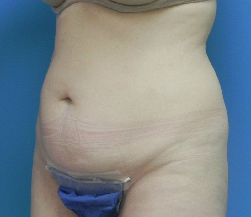Abdominoplasty Before & After Gallery - Patient 202030 - Image 3