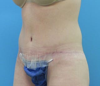 Abdominoplasty Before & After Gallery - Patient 202030 - Image 4