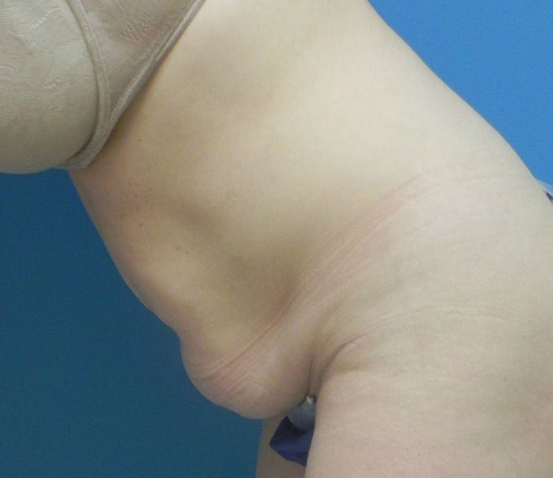 Abdominoplasty Before & After Gallery - Patient 202030 - Image 5