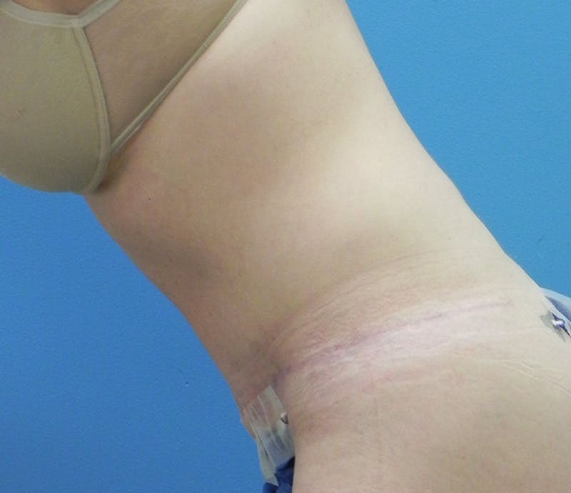 Abdominoplasty Before & After Gallery - Patient 202030 - Image 6
