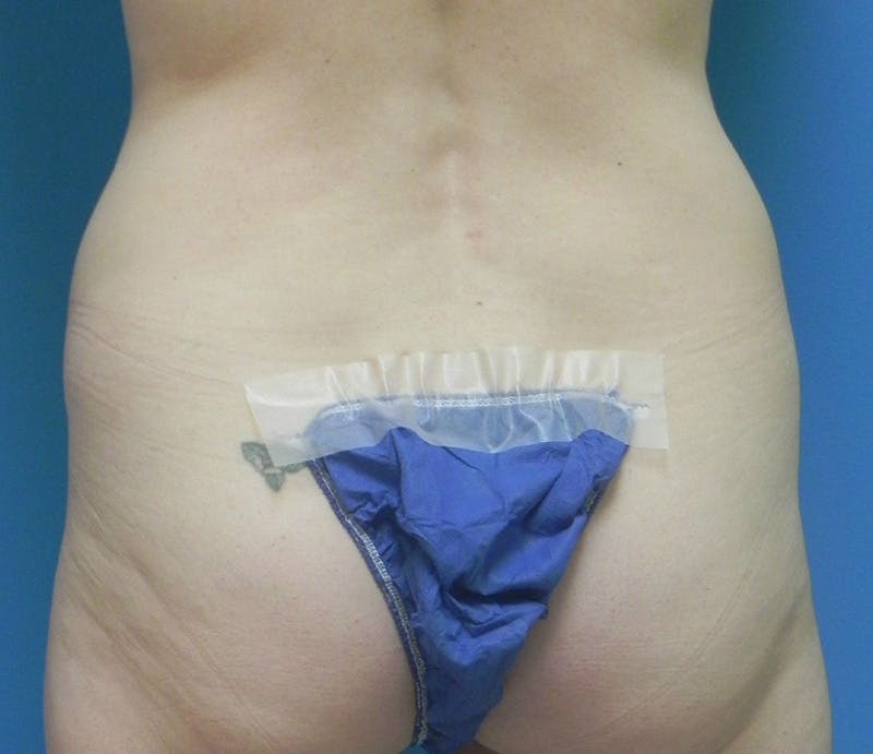 Abdominoplasty Before & After Gallery - Patient 202030 - Image 7