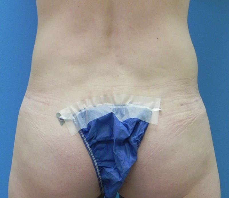 Abdominoplasty Before & After Gallery - Patient 202030 - Image 8