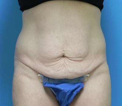 Abdominoplasty Before & After Gallery - Patient 585113 - Image 1