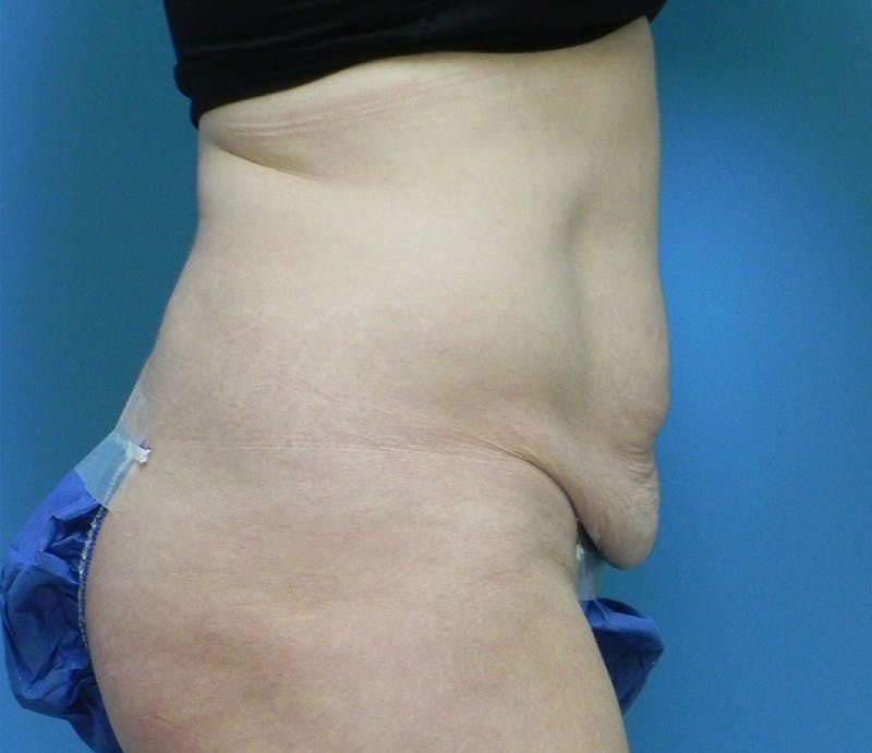 Abdominoplasty Before & After Gallery - Patient 585113 - Image 5
