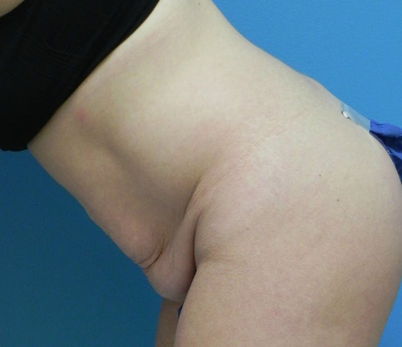 Abdominoplasty Before & After Gallery - Patient 585113 - Image 7