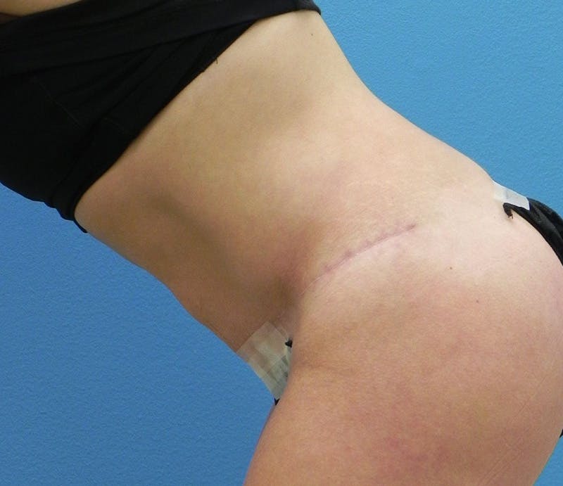 Abdominoplasty Before & After Gallery - Patient 585113 - Image 8