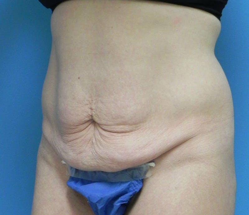 Abdominoplasty Before & After Gallery - Patient 585113 - Image 3
