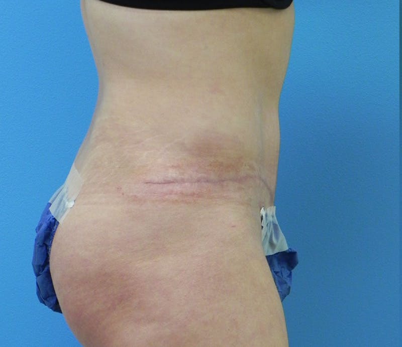 Abdominoplasty Before & After Gallery - Patient 585113 - Image 6