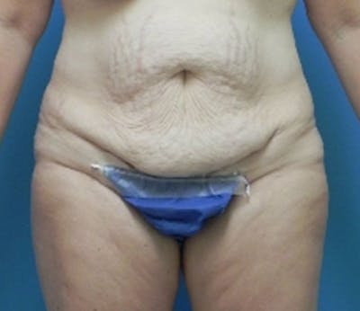 Abdominoplasty Before & After Gallery - Patient 296531 - Image 1