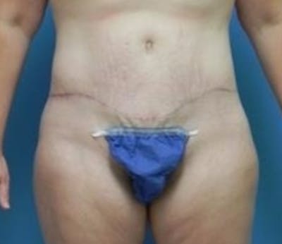 Abdominoplasty Before & After Gallery - Patient 296531 - Image 2