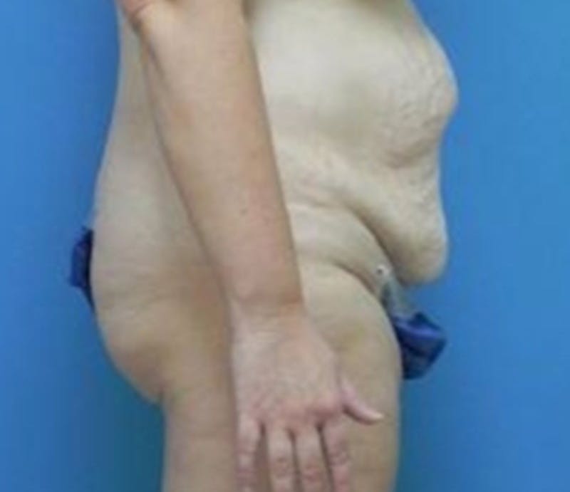 Abdominoplasty Before & After Gallery - Patient 296531 - Image 5