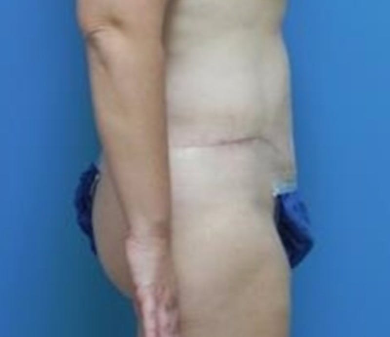 Abdominoplasty Before & After Gallery - Patient 296531 - Image 6
