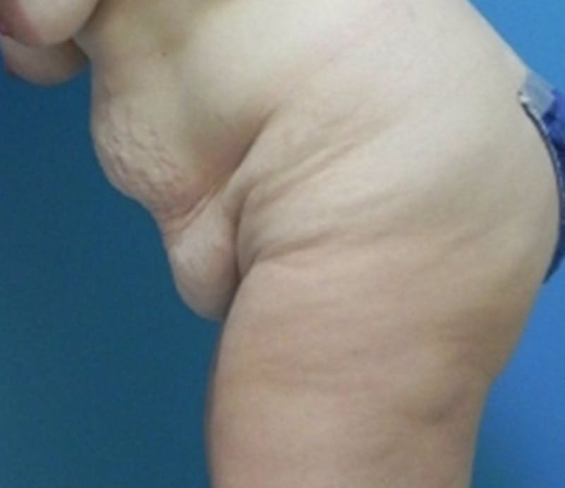 Abdominoplasty Before & After Gallery - Patient 296531 - Image 7