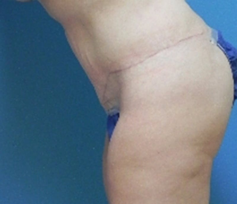 Abdominoplasty Before & After Gallery - Patient 296531 - Image 8