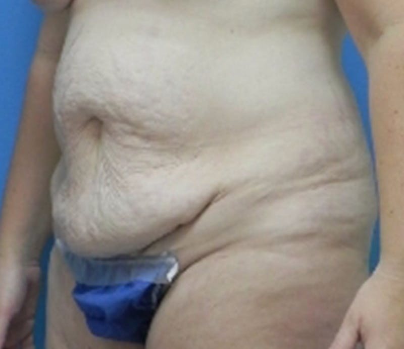 Abdominoplasty Before & After Gallery - Patient 296531 - Image 3