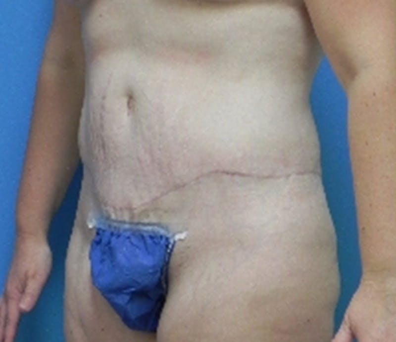Abdominoplasty Before & After Gallery - Patient 296531 - Image 4