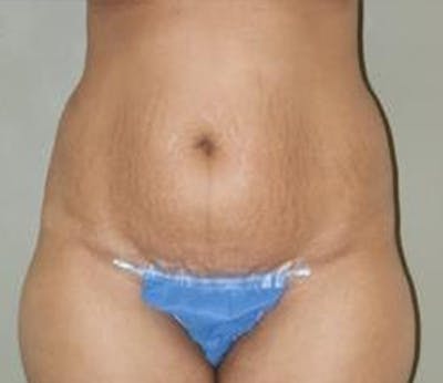 Abdominoplasty Before & After Gallery - Patient 325453 - Image 1