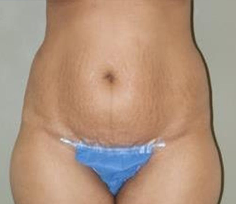 Abdominoplasty Before & After Gallery - Patient 325453 - Image 1