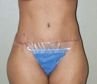 Abdominoplasty Before & After Gallery - Patient 325453 - Image 2