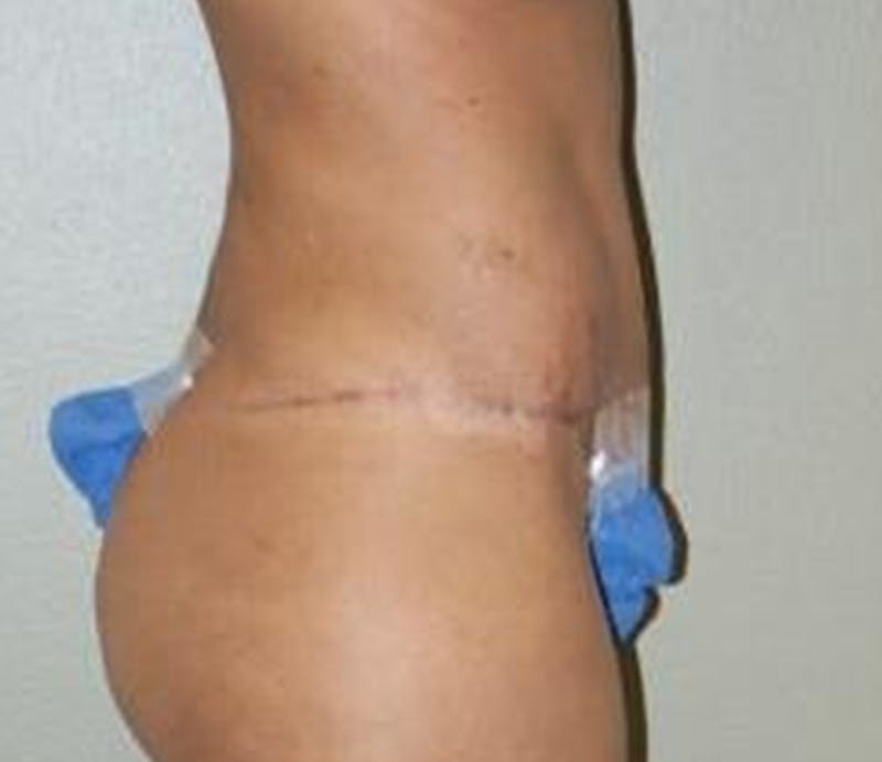 Abdominoplasty Before & After Gallery - Patient 325453 - Image 4